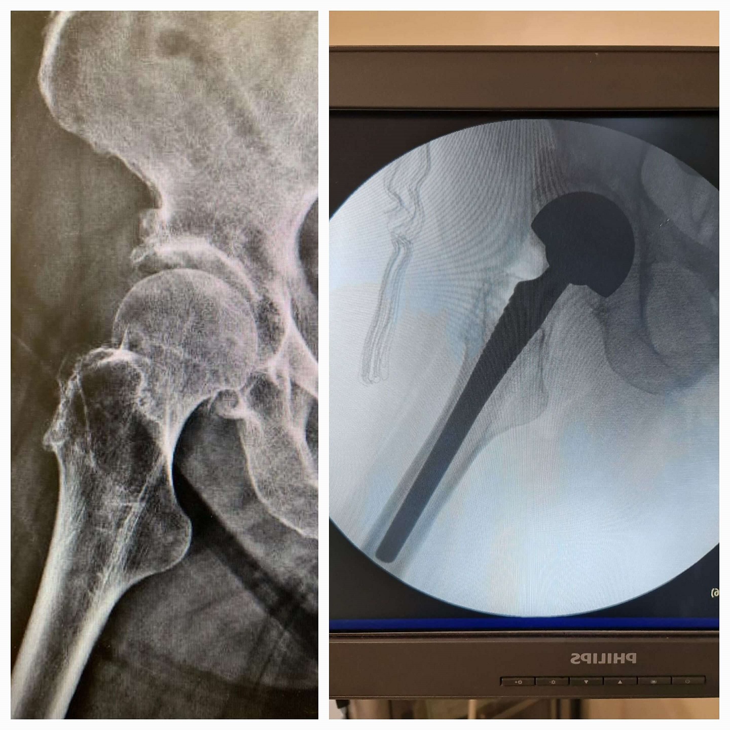 artroplastia-total-do-quadril-3