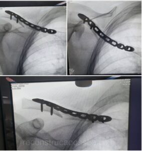 fratura-da-clavicula-8