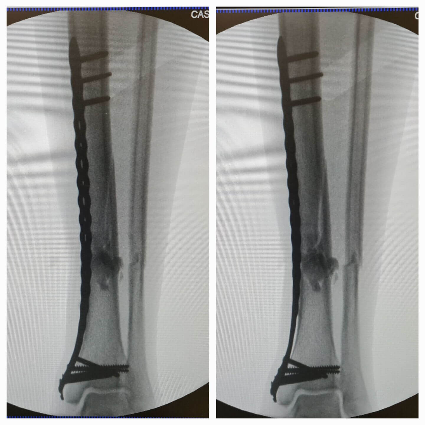 fratura-da-tibia-2