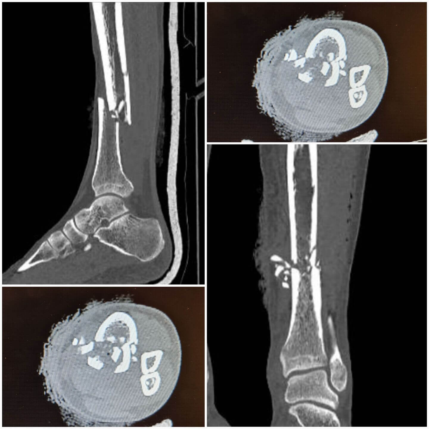 fratura-da-tibia-4