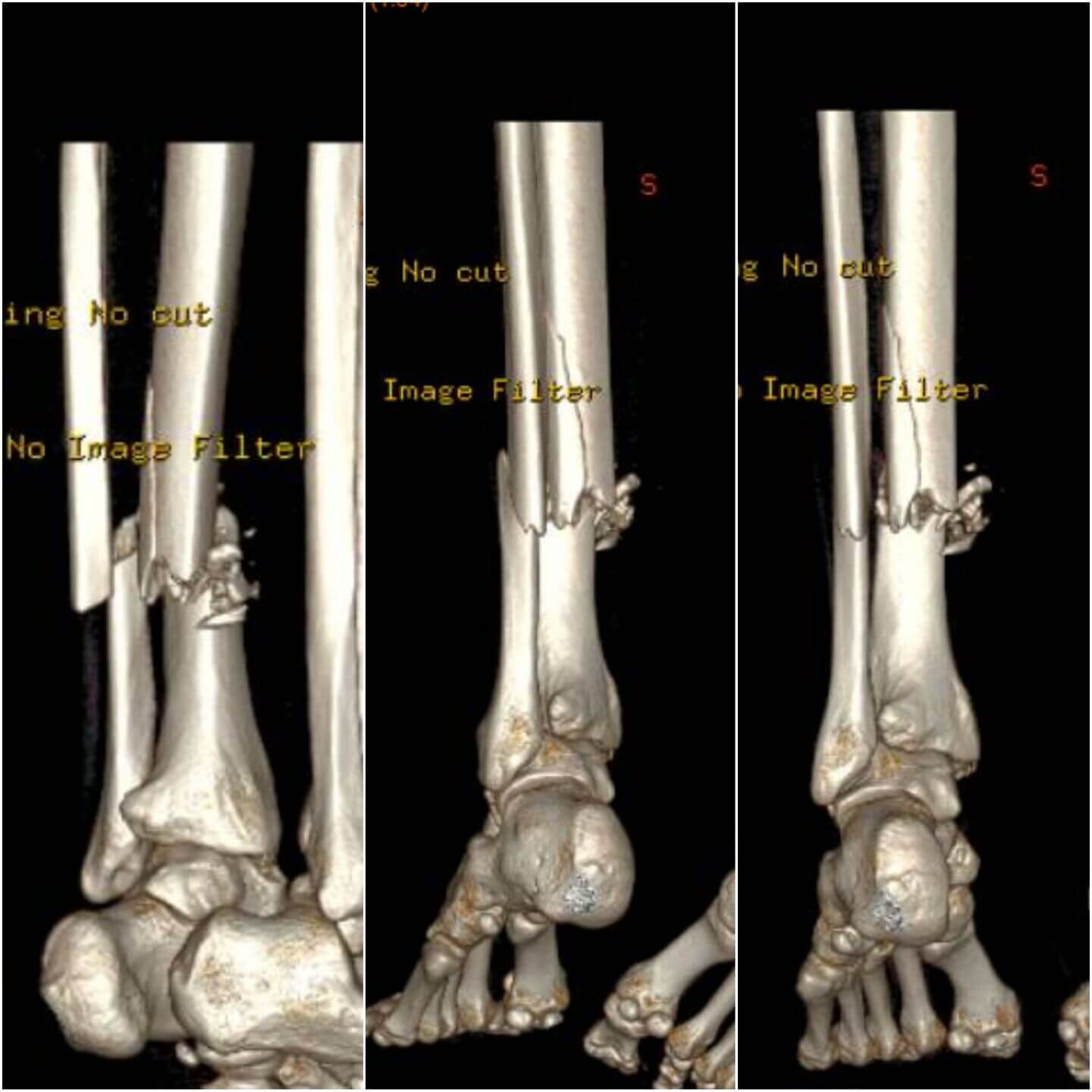 fratura-da-tibia-5