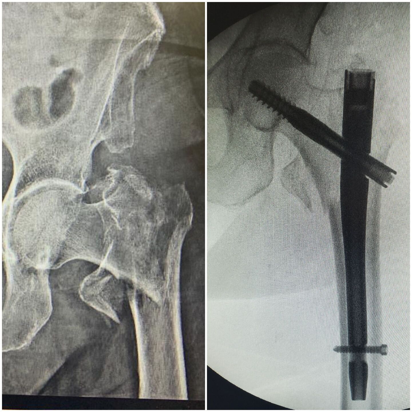 fratura-do-1-3-proximal-do-femur