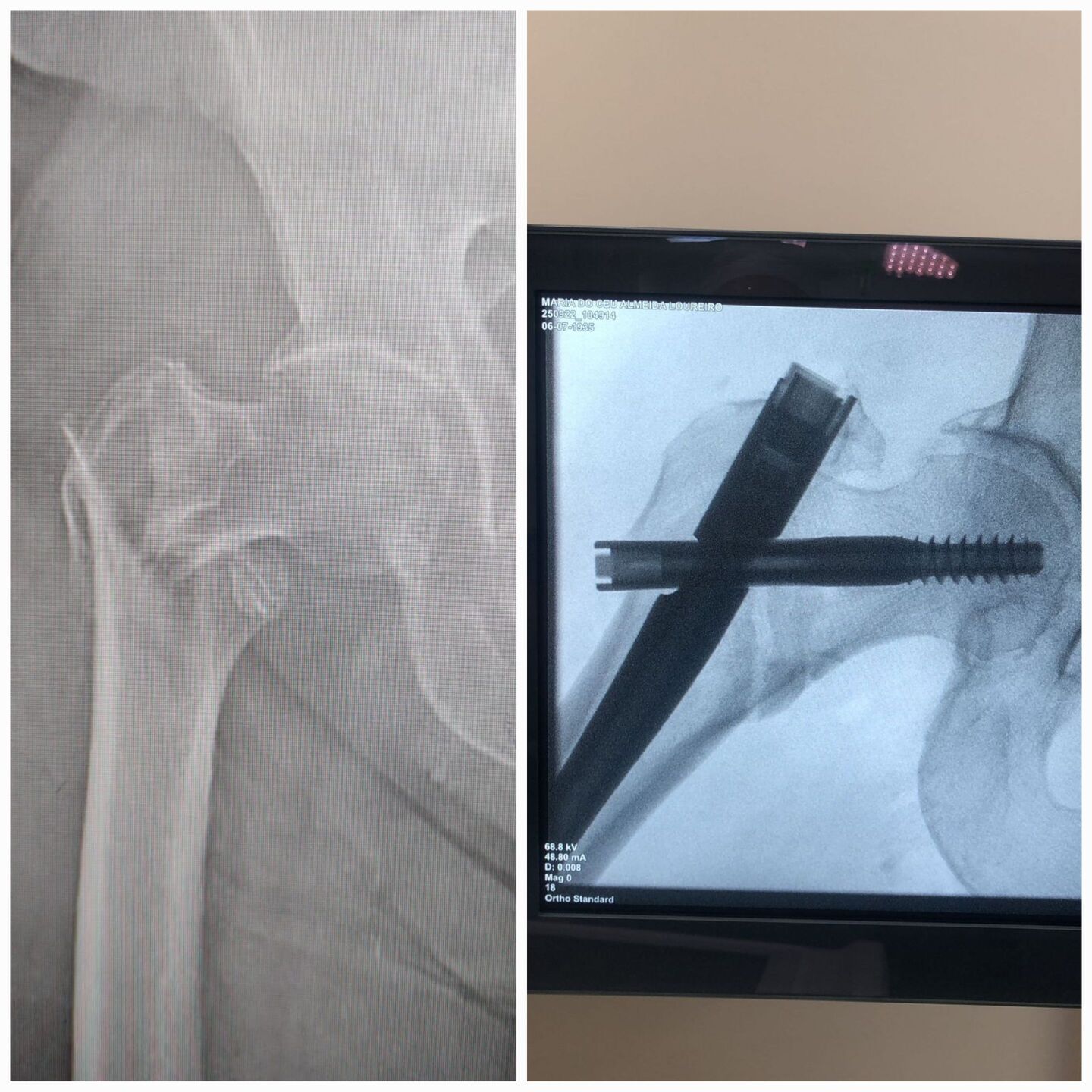 fratura-do-13-proximal-do-femur-14