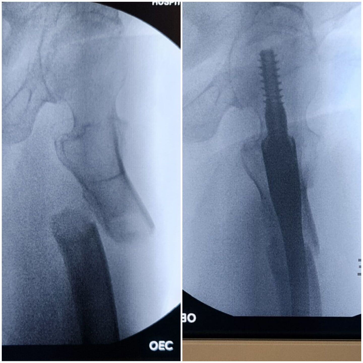 fratura-do-13-proximal-do-femur-3