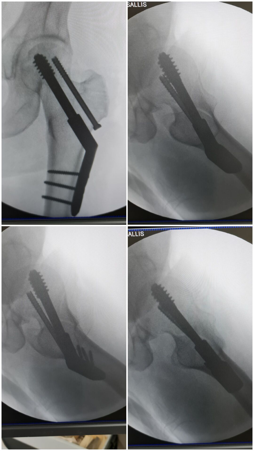 fratura-do-13-proximal-do-femur-5