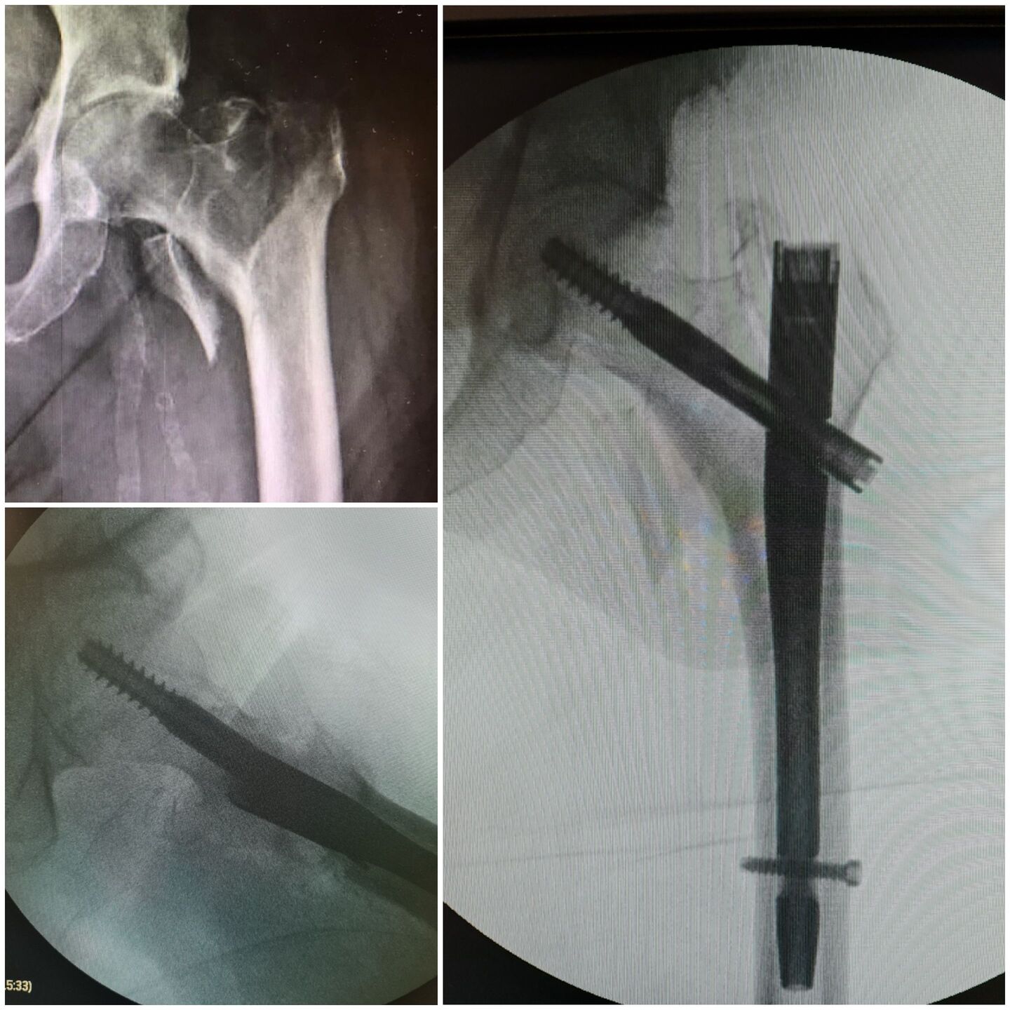 fratura-do-13-proximal-do-femur-7