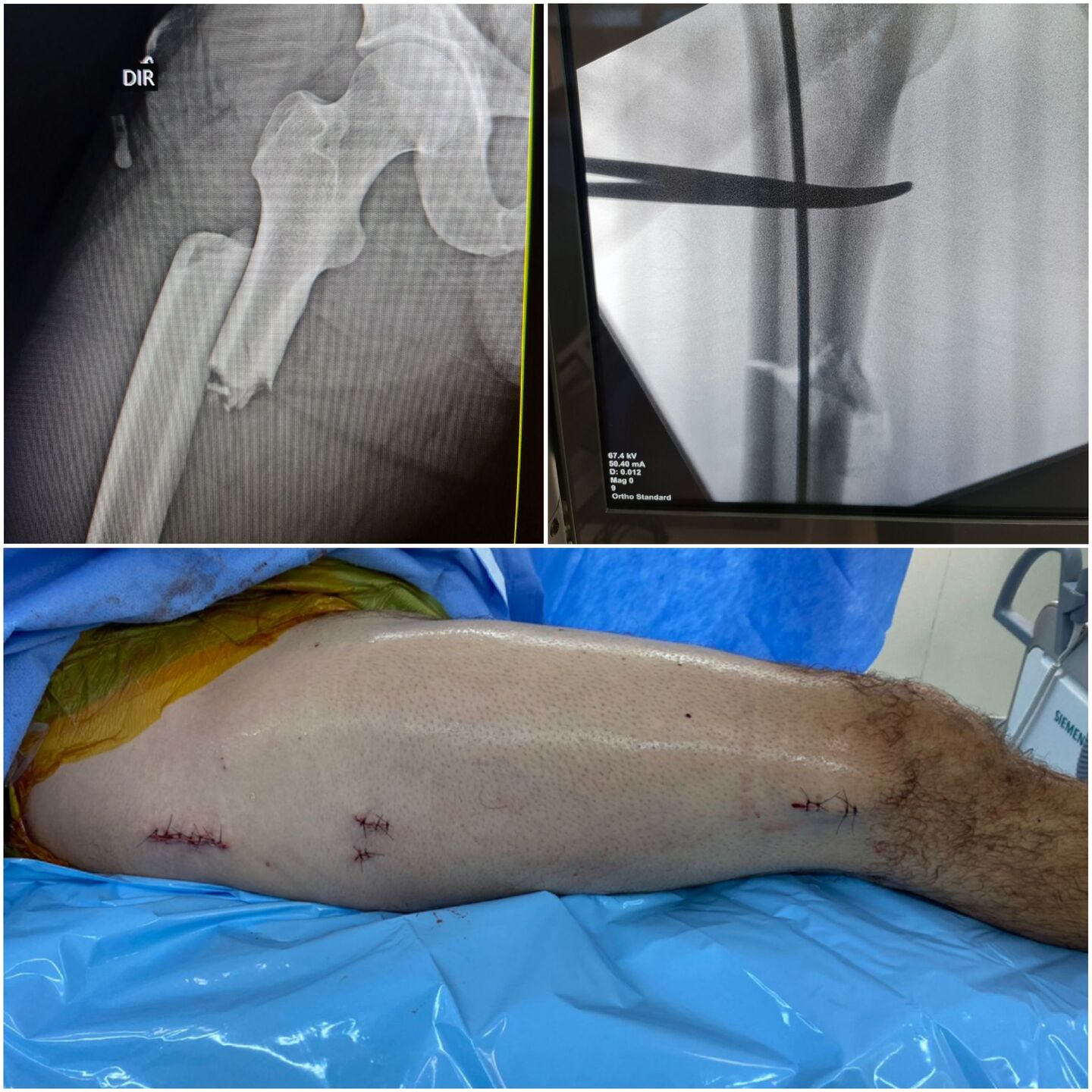 fratura-do-13-proximal-do-femur-8