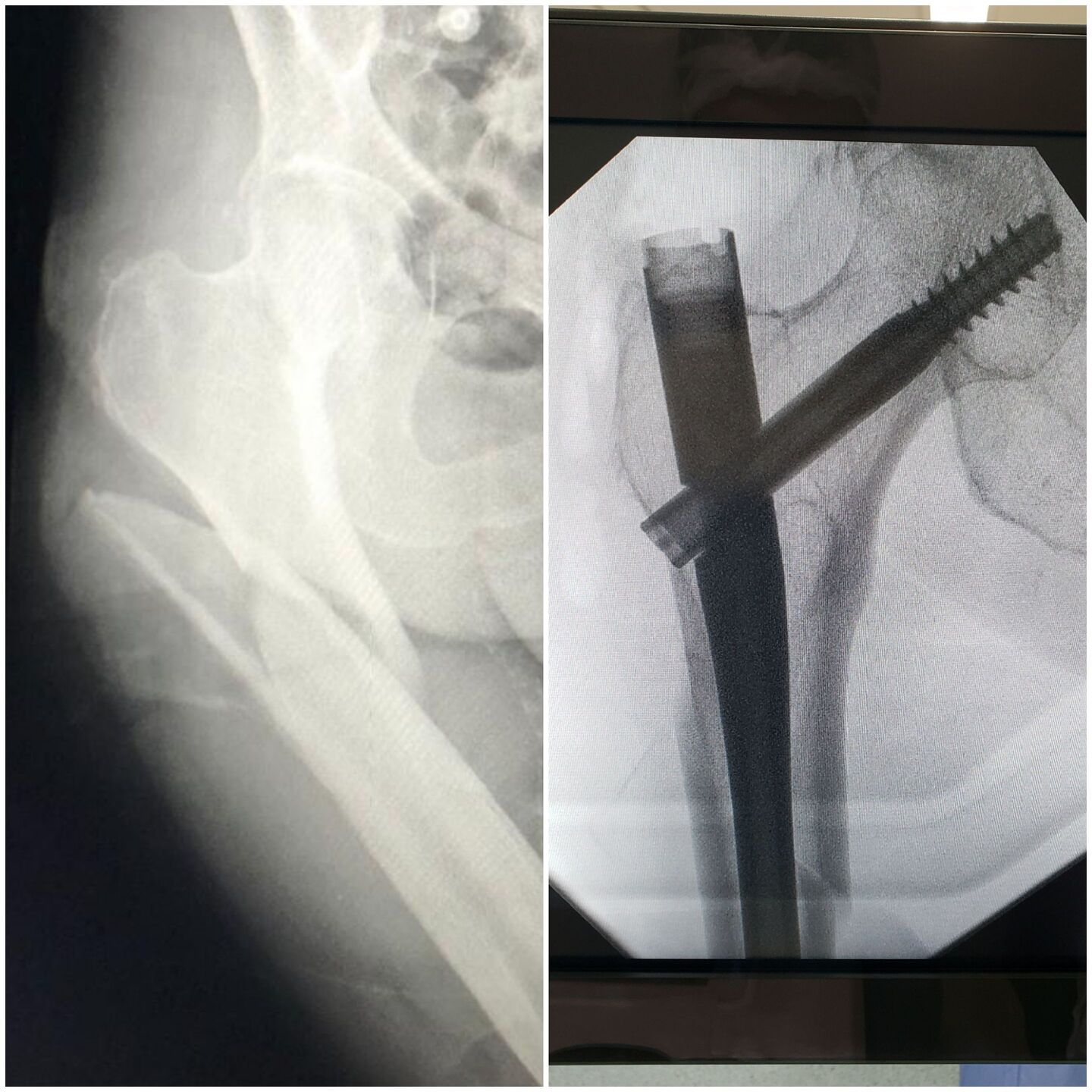 fratura-do-13-proximal-do-femur