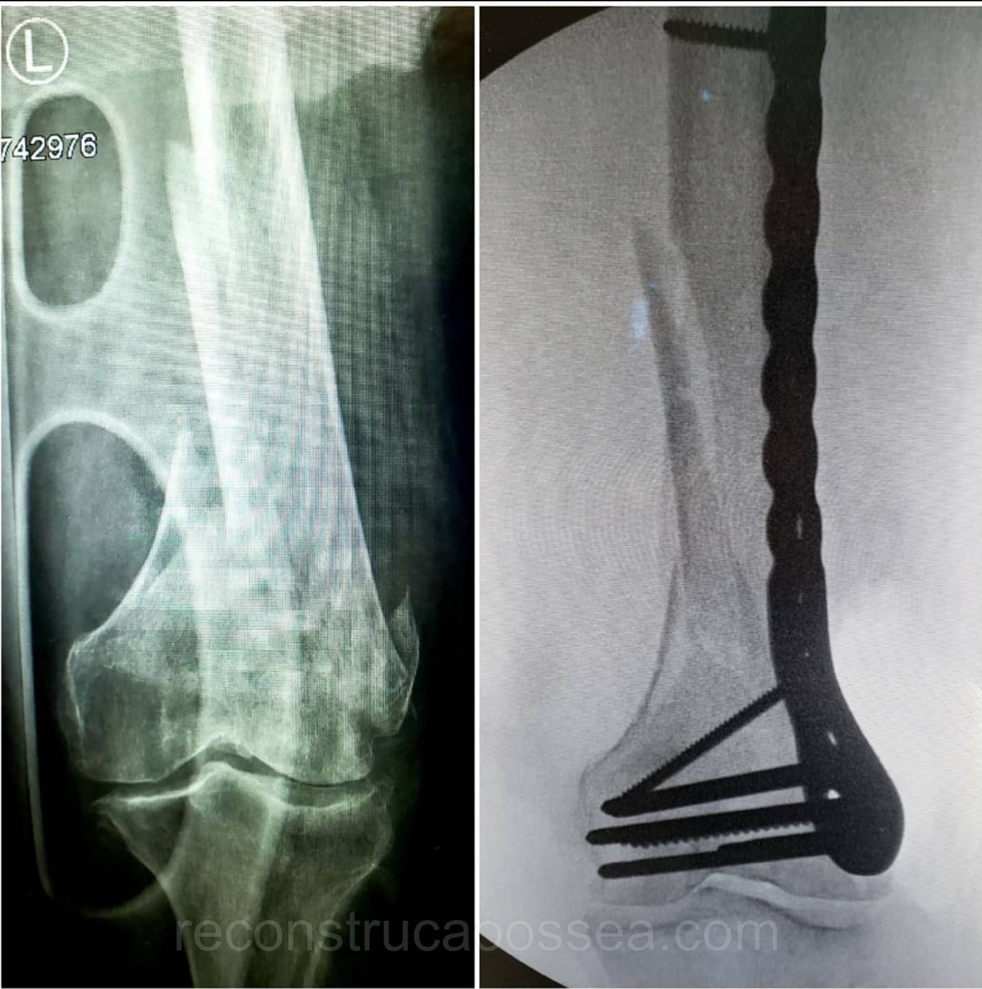 fratura-do-femur-distal-1