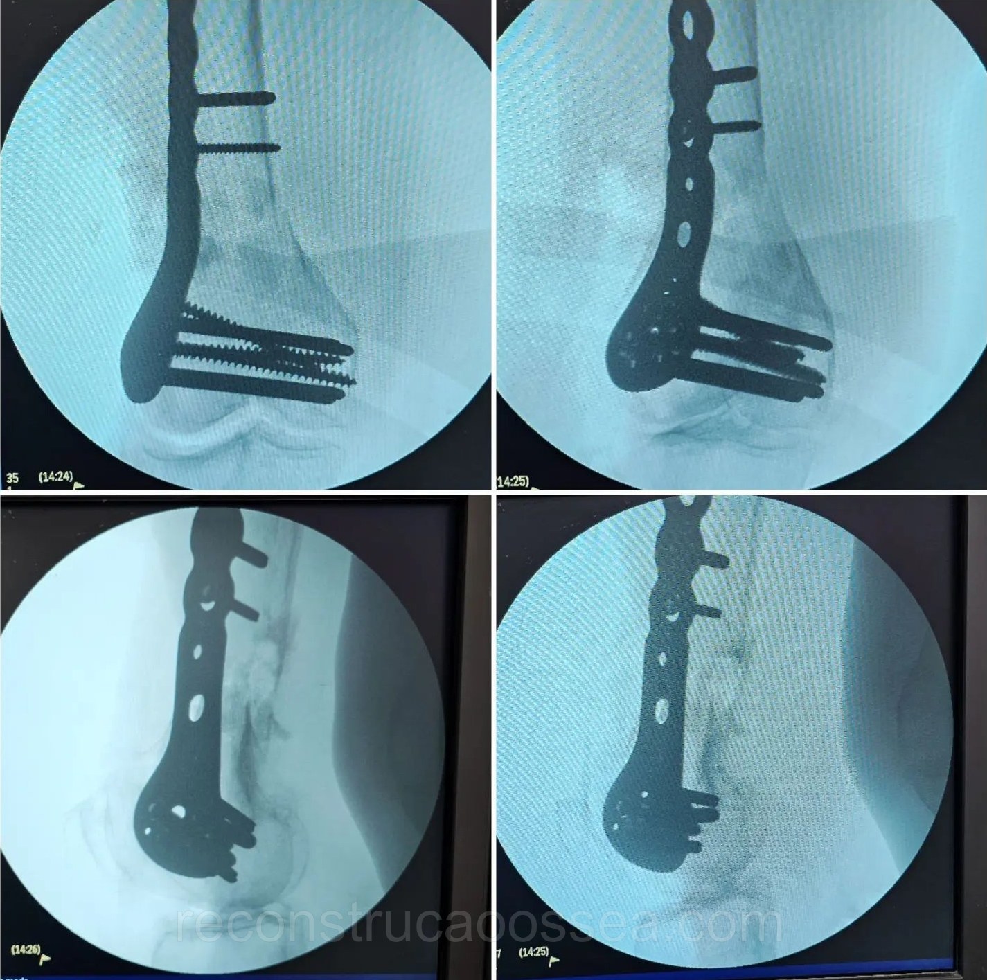 fratura-do-femur-distal-10