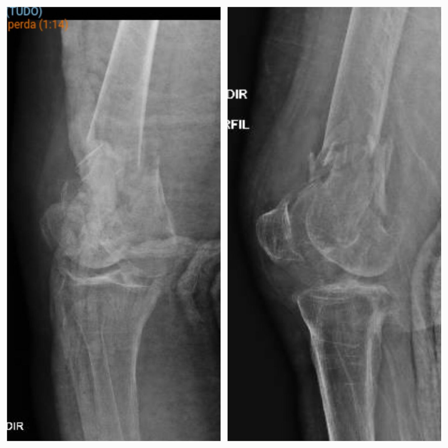 fratura-do-femur-distal-2