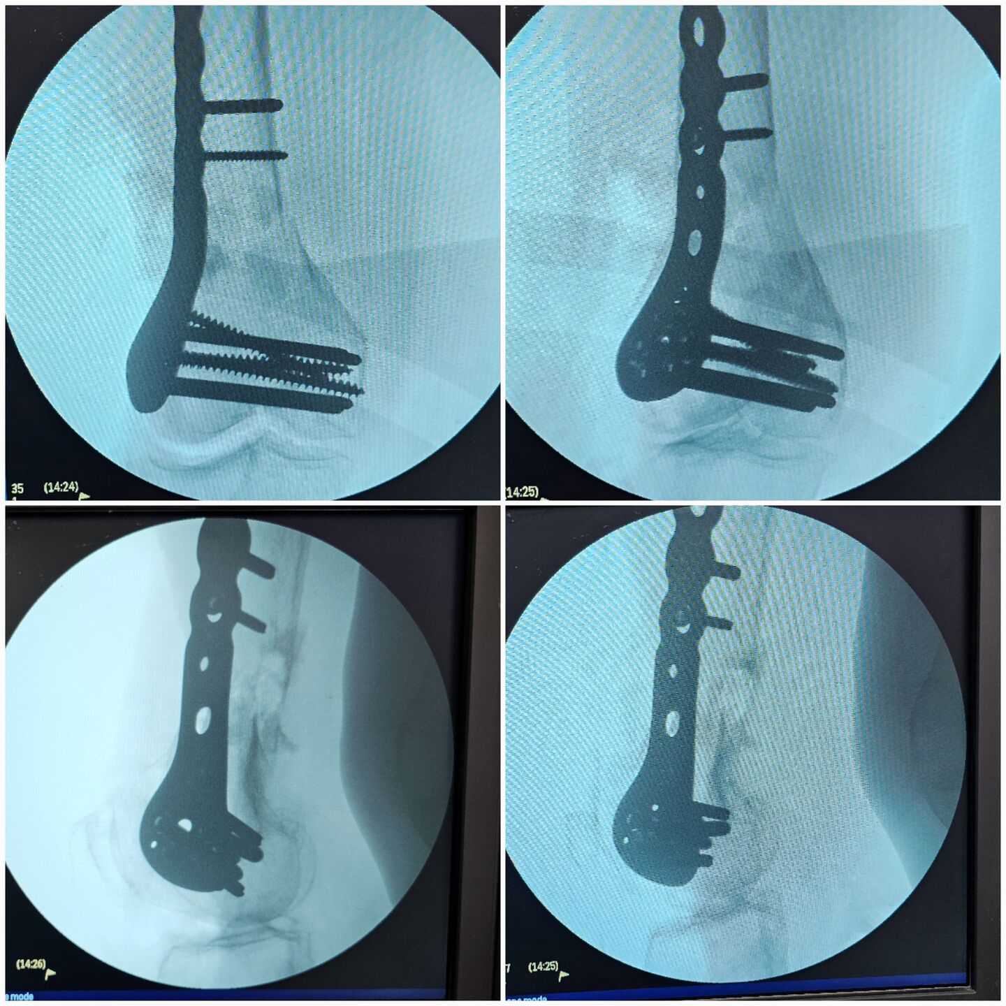 fratura-do-femur-distal-3