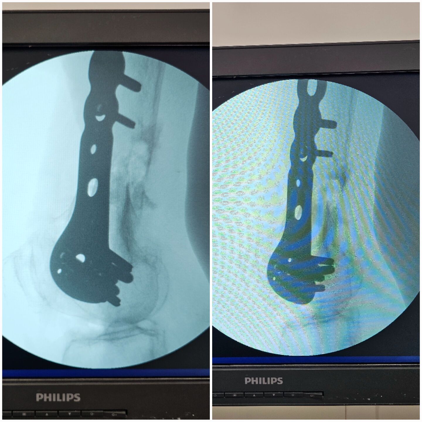 fratura-do-femur-distal-4-2