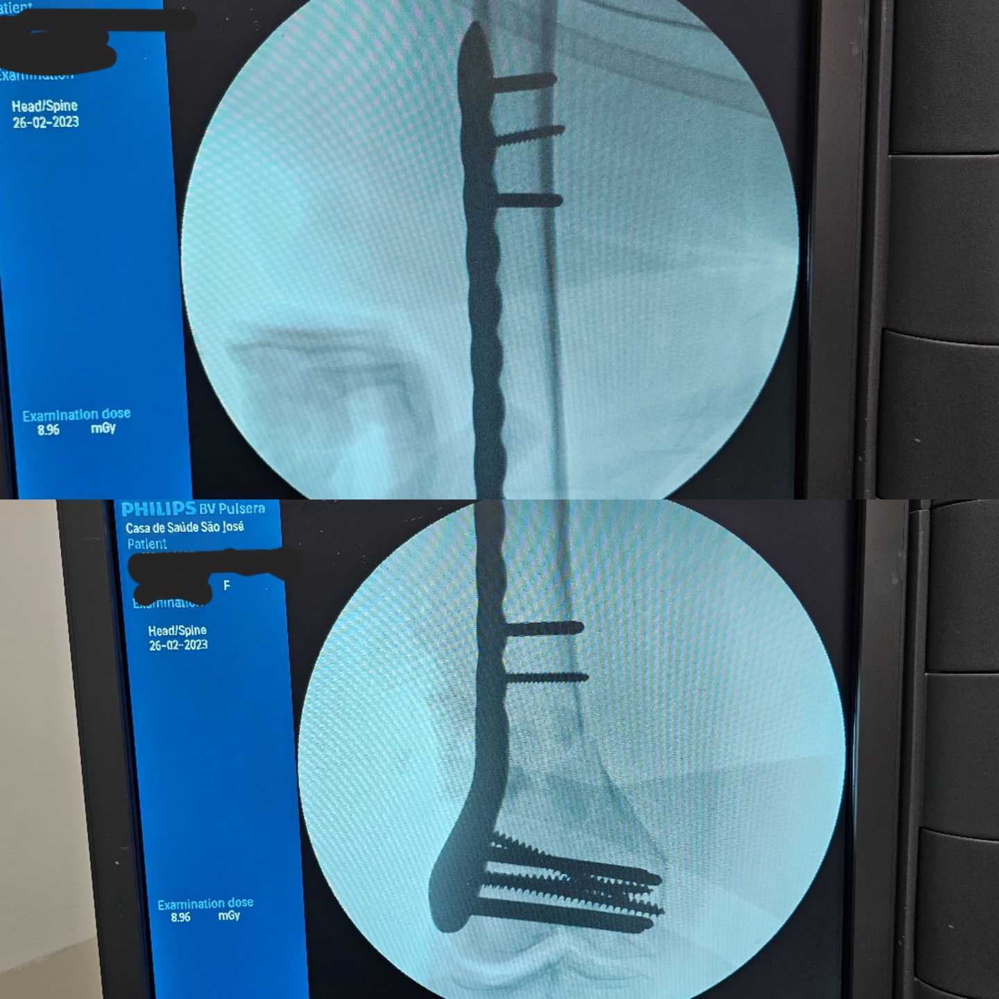 fratura-do-femur-distal-4