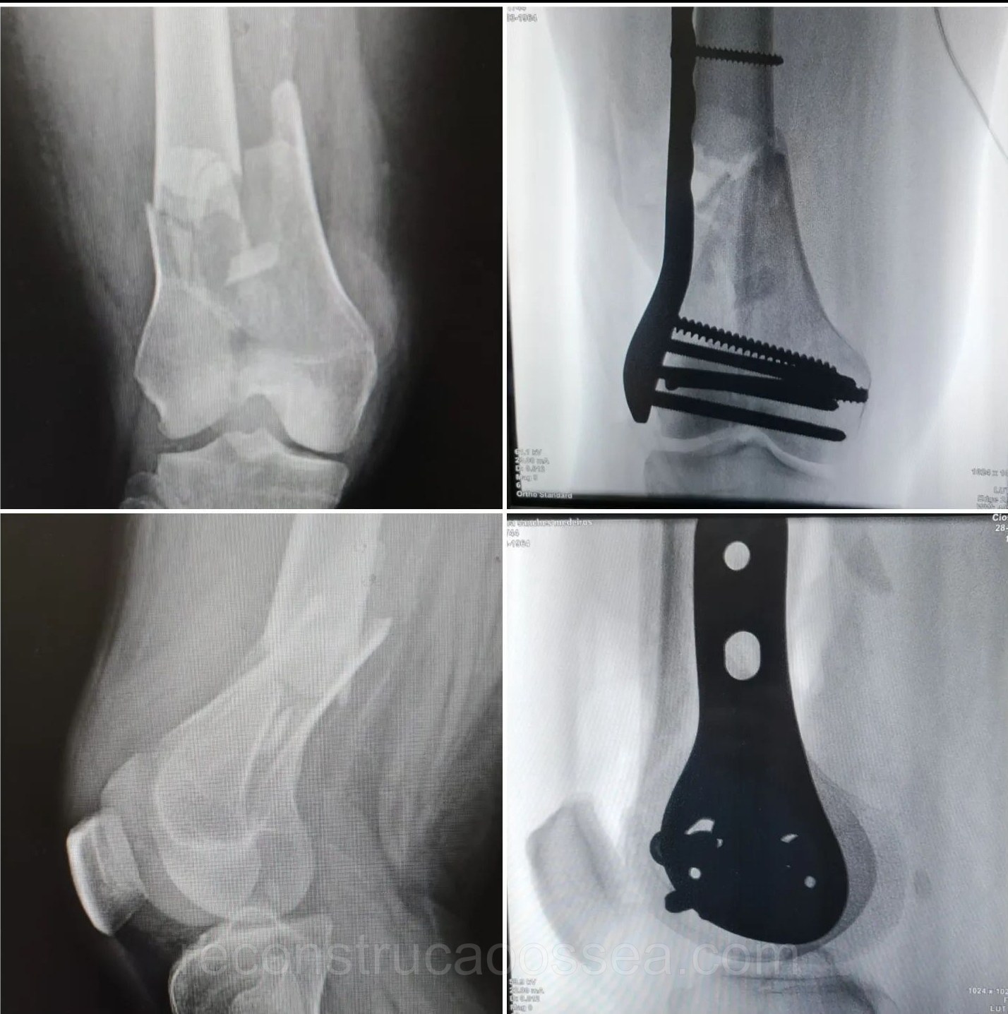 fratura-do-femur-distal-6