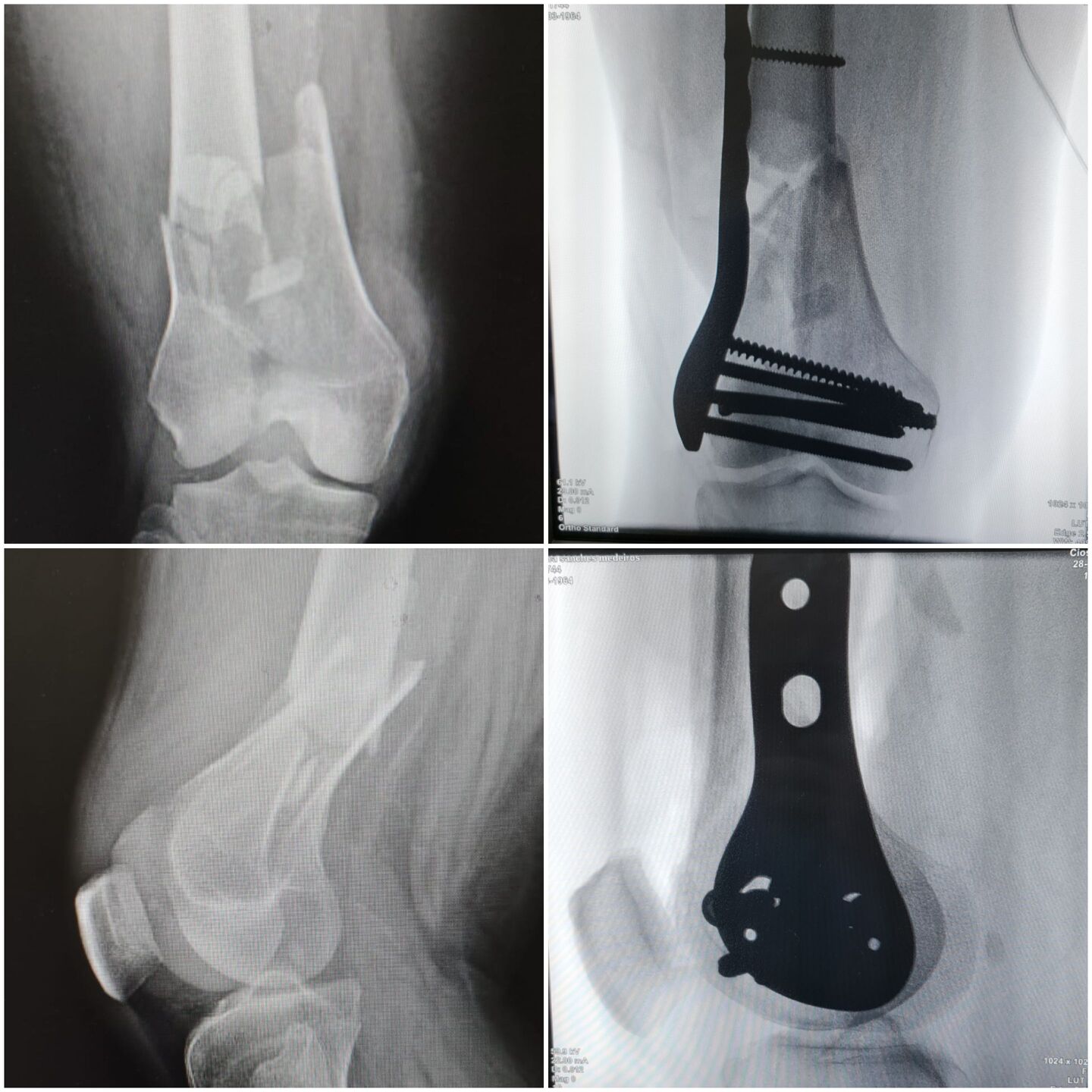 fratura-do-femur-distal-6