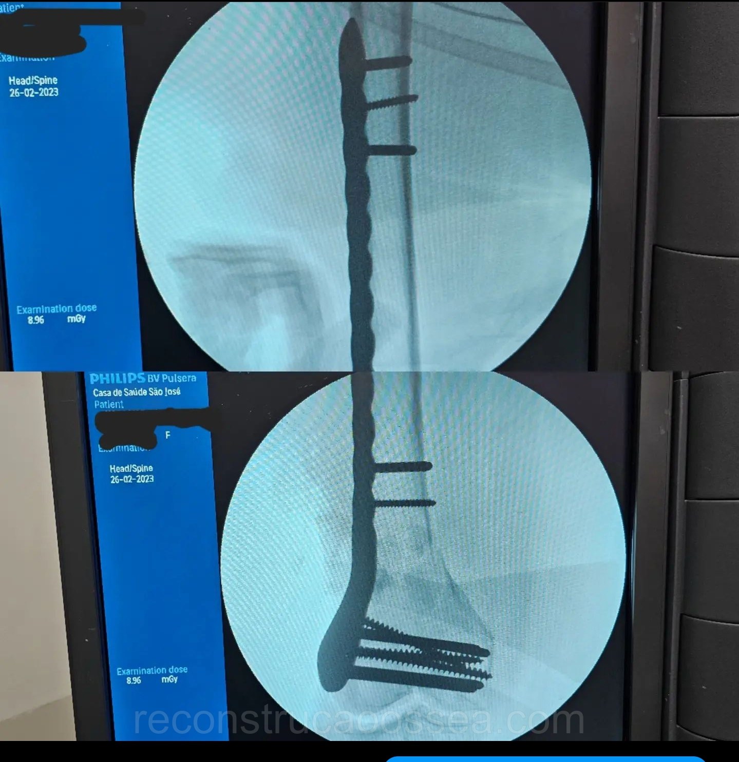 fratura-do-femur-distal-9