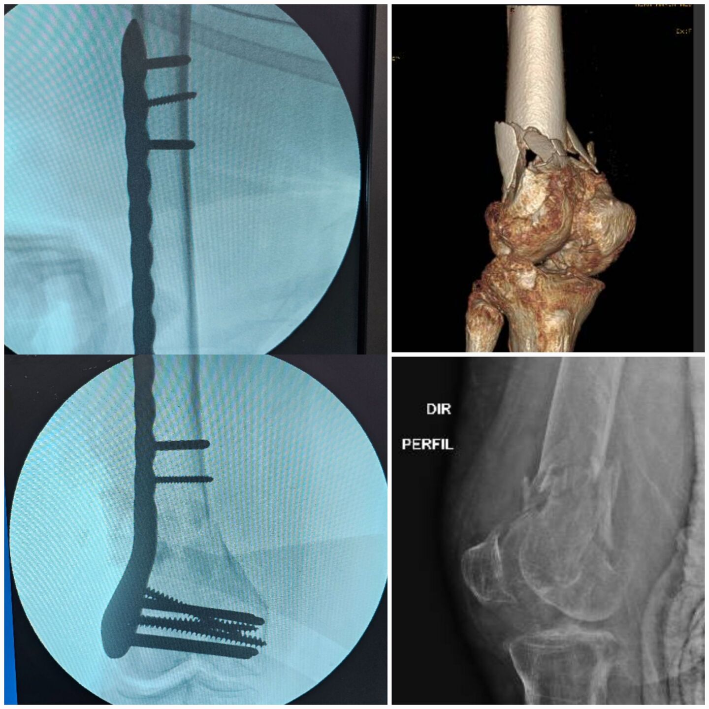 fratura-do-femur-distal