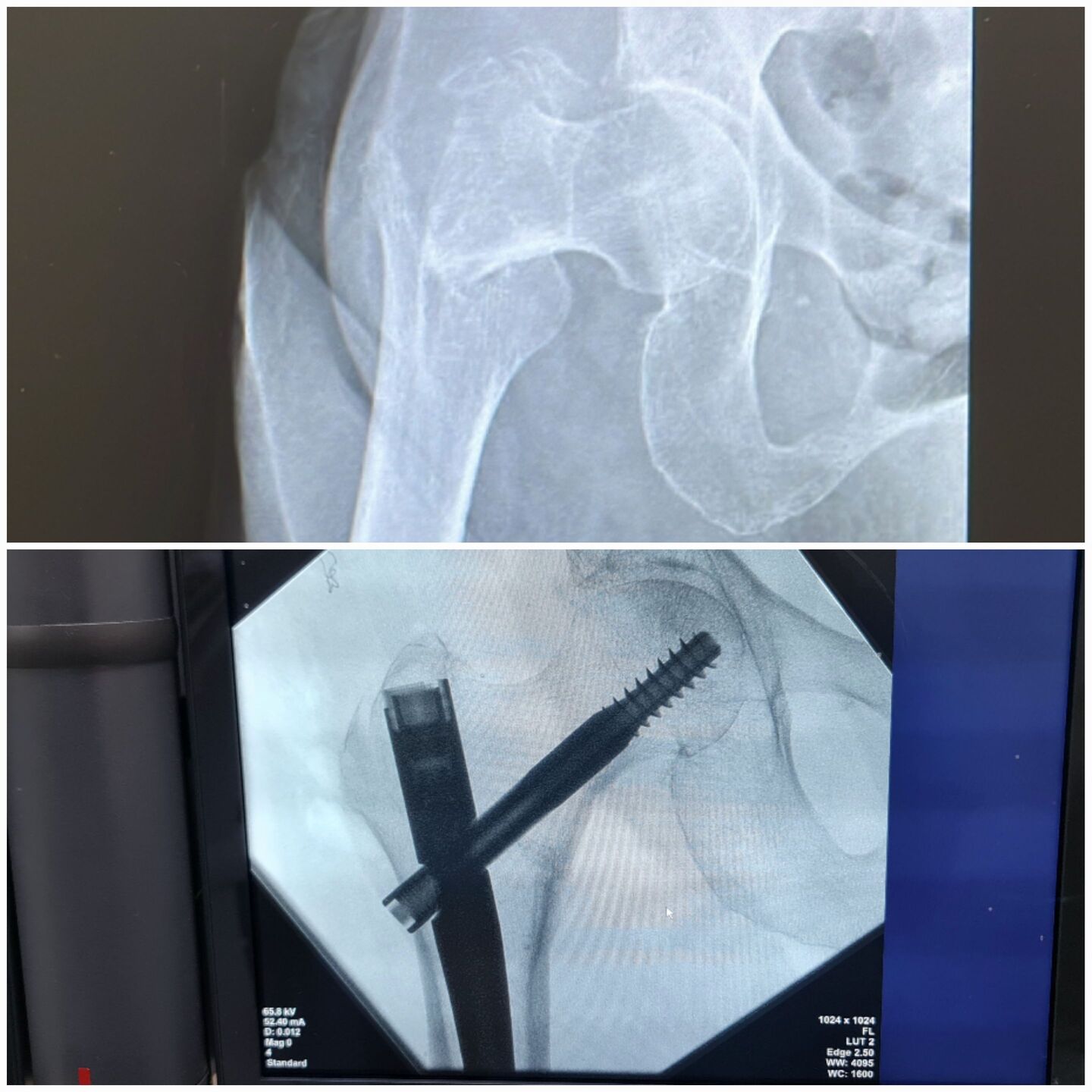 fratura-do-femur-proximal-2