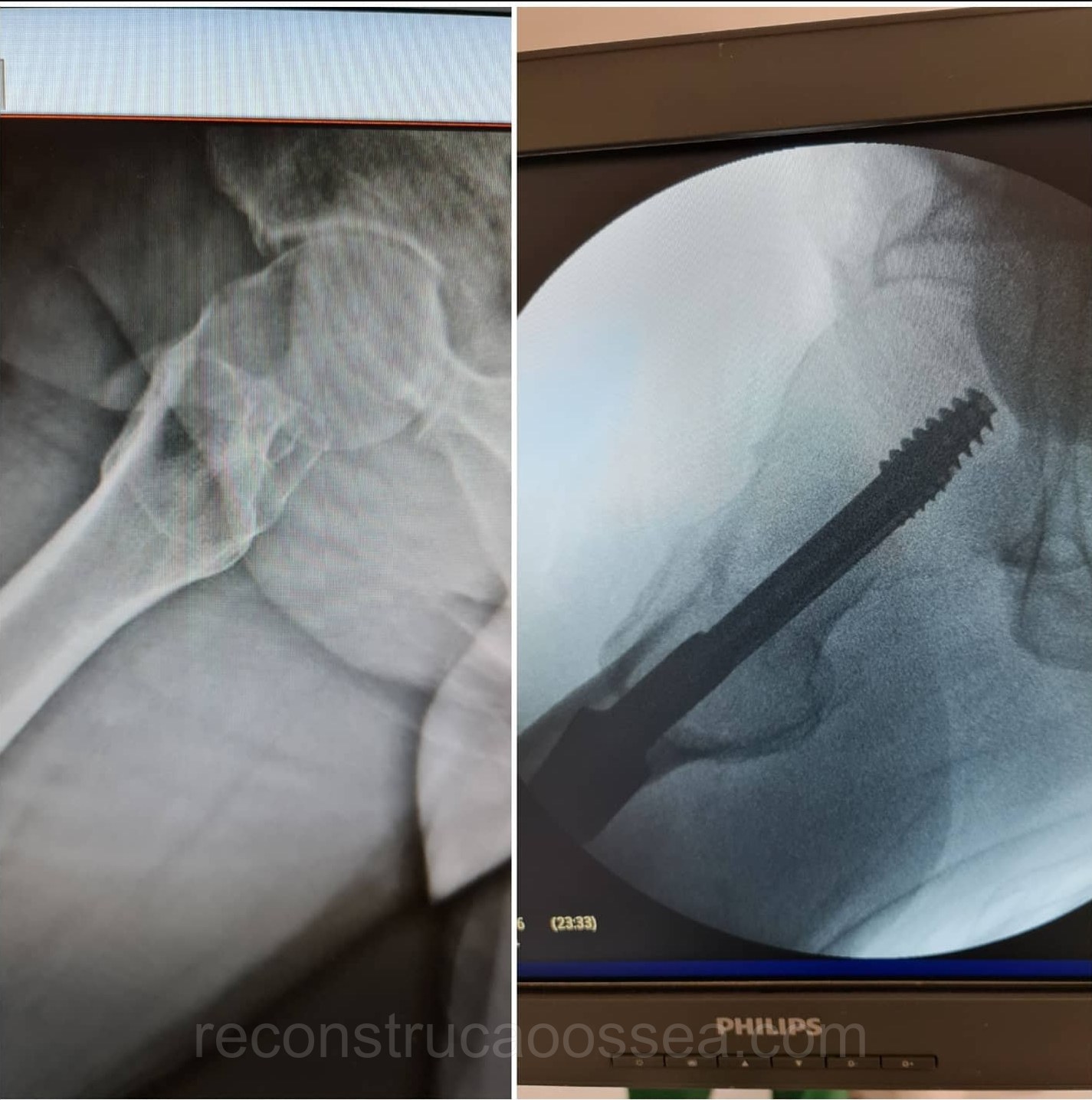 fratura-do-femur-proximal-tratamento-cirurgico-10