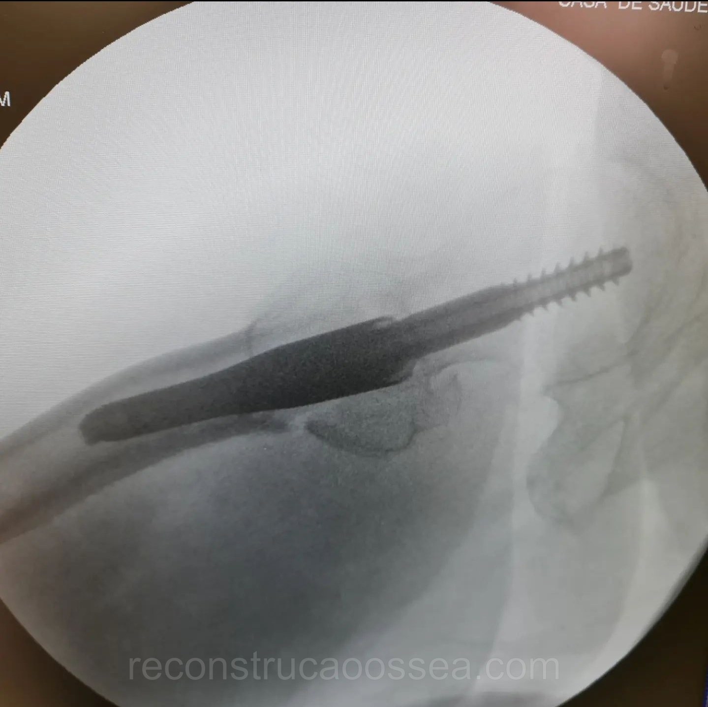 fratura-do-femur-proximal-tratamento-cirurgico-12