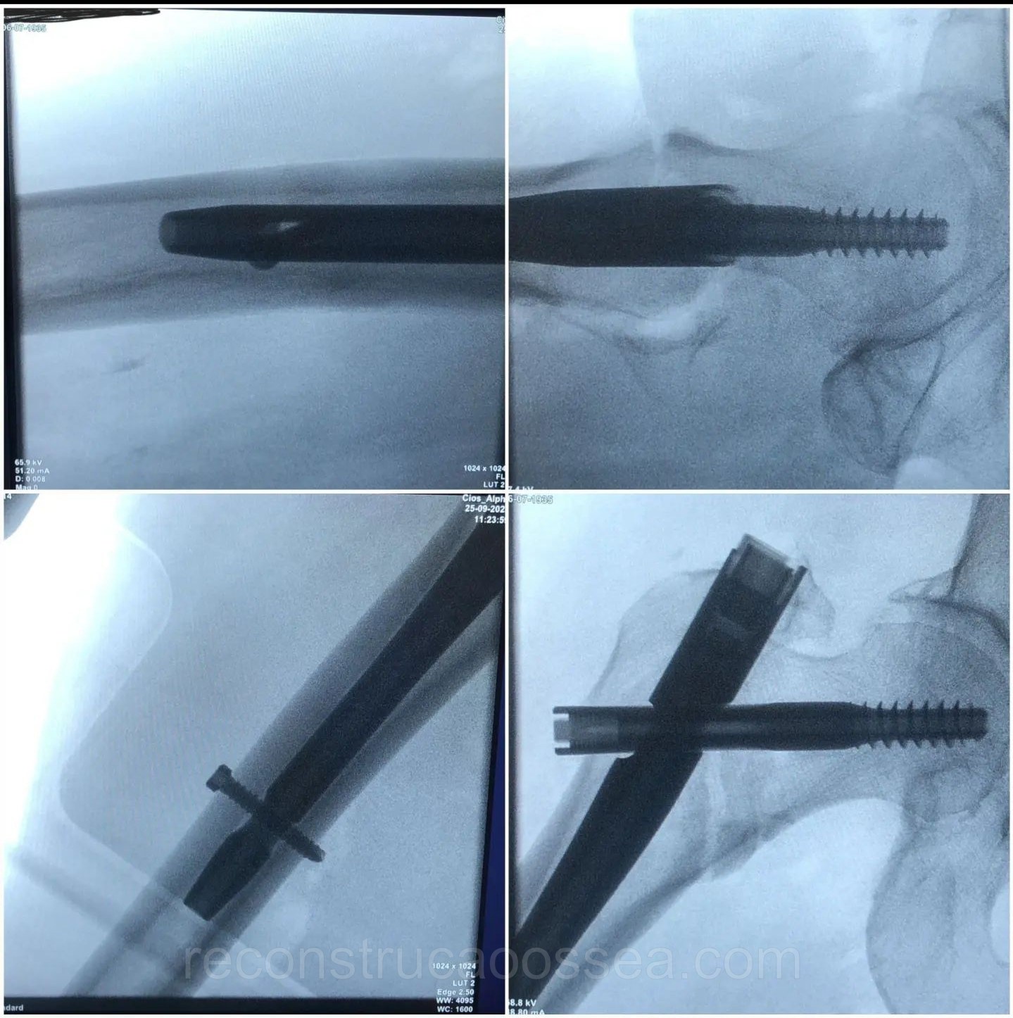 fratura-do-femur-proximal-tratamento-cirurgico-16