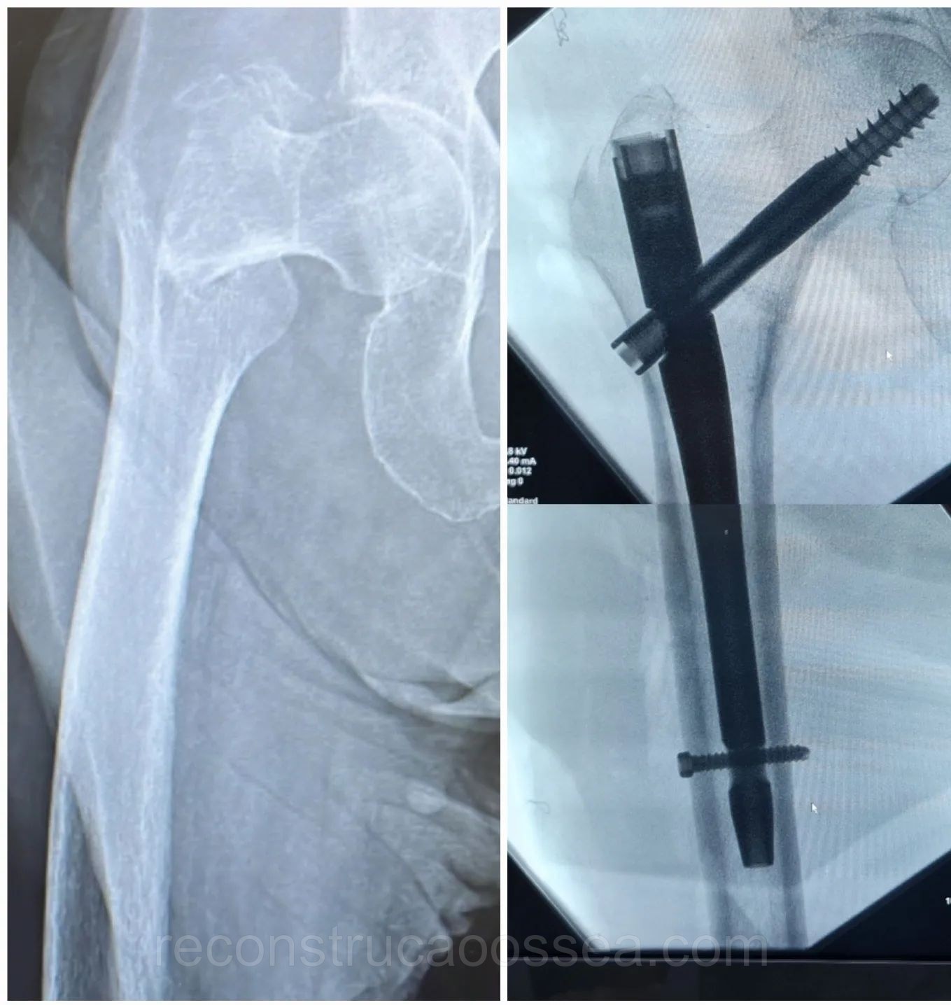 fratura-do-femur-proximal-tratamento-cirurgico-17