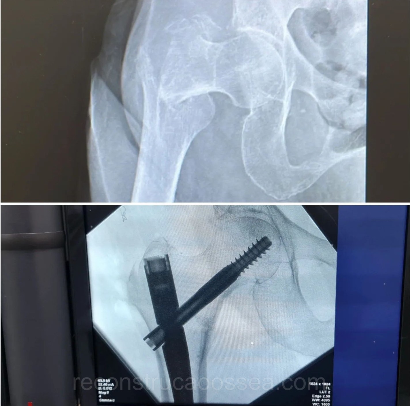 fratura-do-femur-proximal-tratamento-cirurgico-18