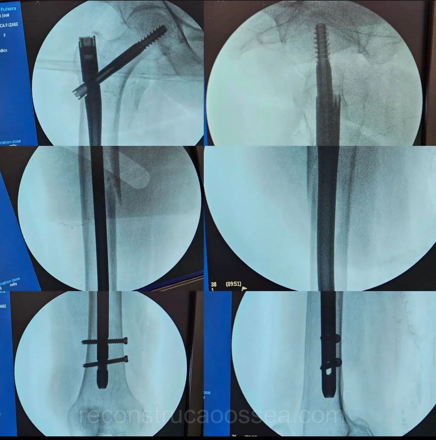 fratura-do-femur-proximal-tratamento-cirurgico-19