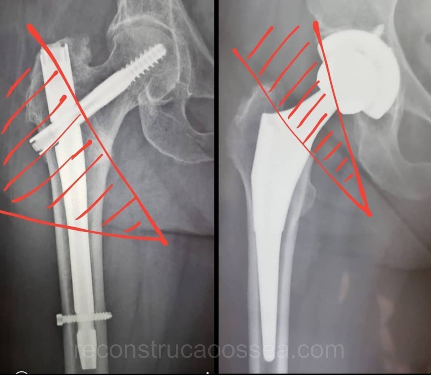 fratura-do-femur-proximal-tratamento-cirurgico-2