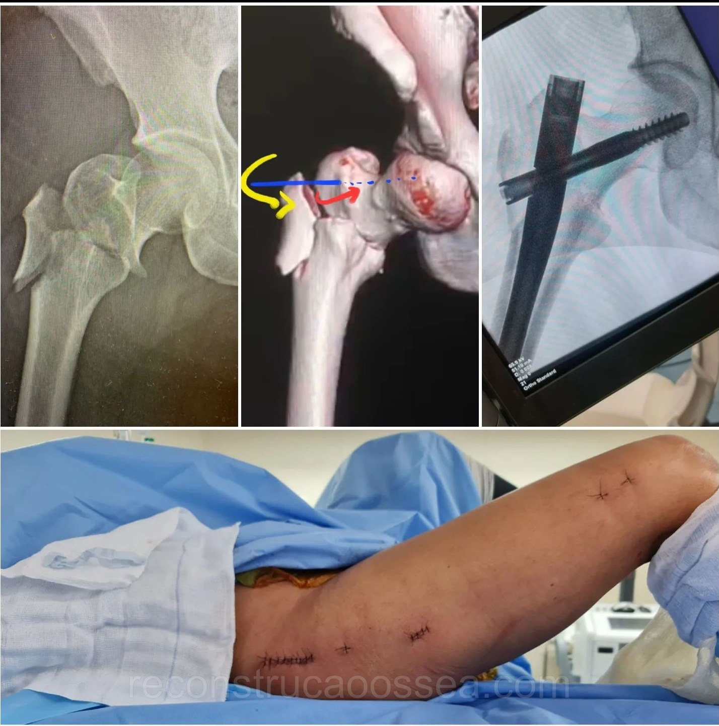 fratura-do-femur-proximal-tratamento-cirurgico-24