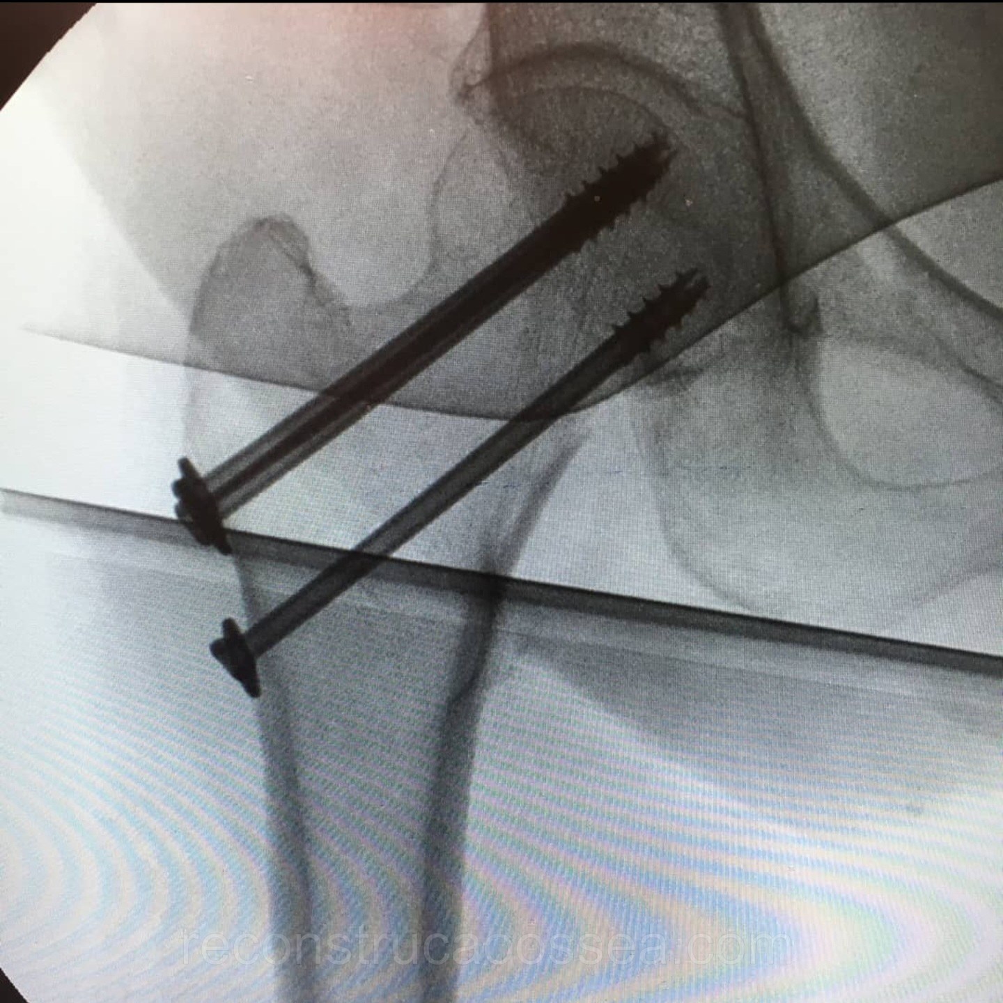 fratura-do-femur-proximal-tratamento-cirurgico-3