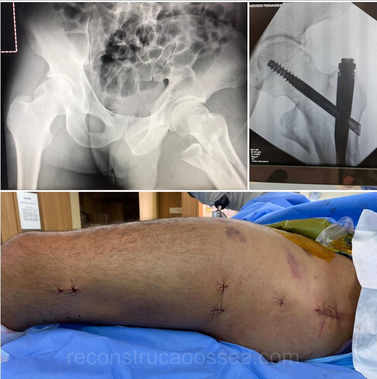 fratura-do-femur-proximal-tratamento-cirurgico-8