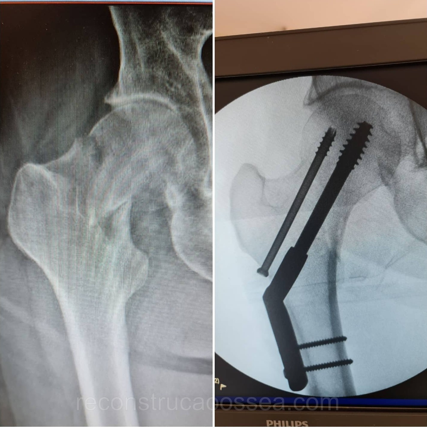 fratura-do-femur-proximal-tratamento-cirurgico-9