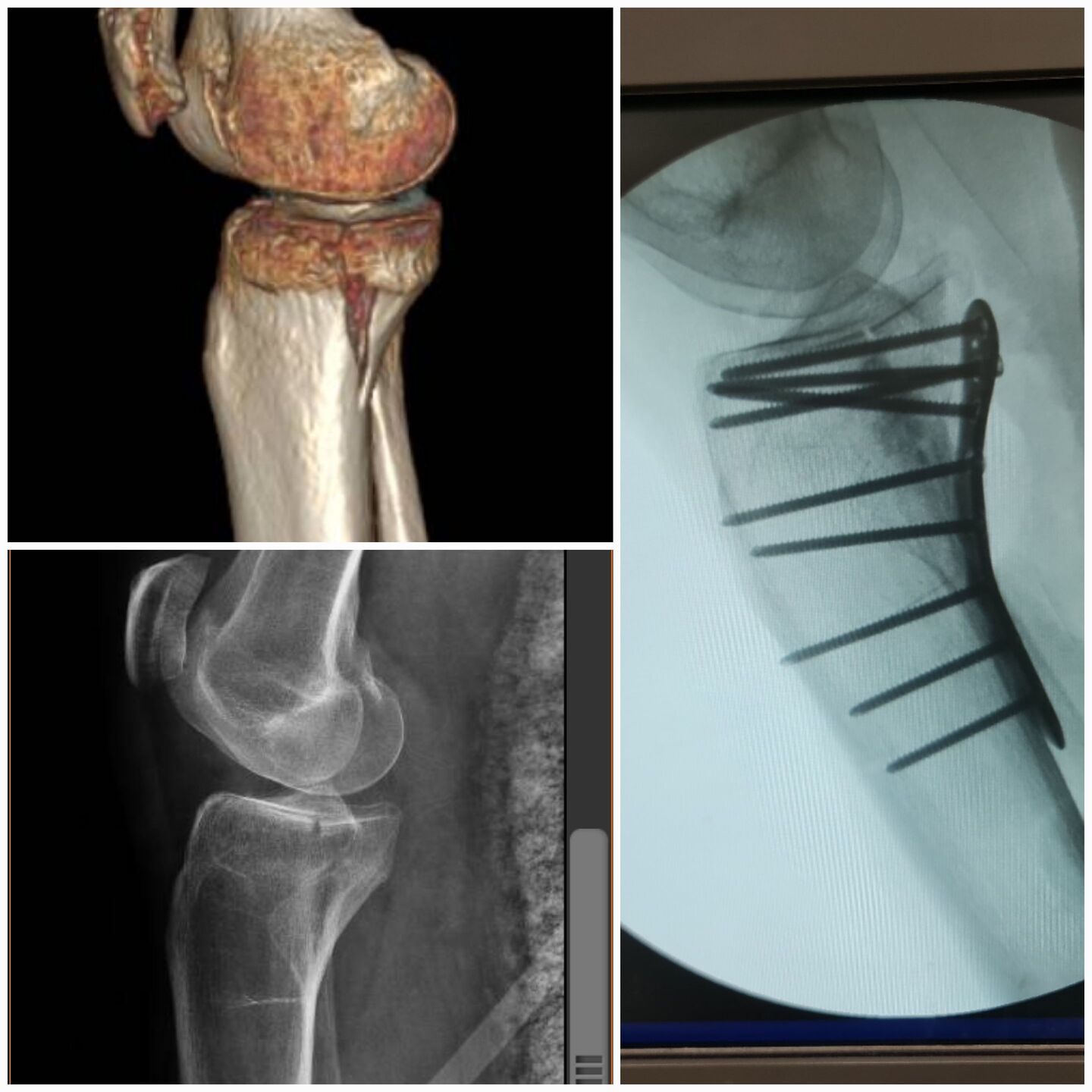 fratura-do-planalto-tibial-3