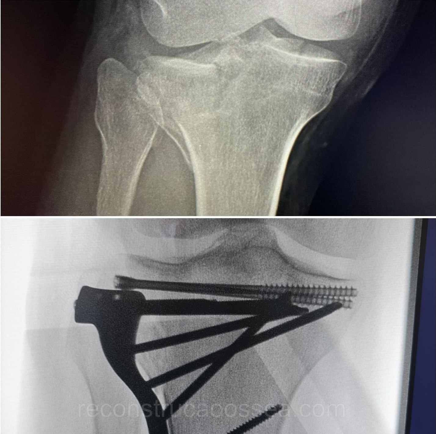 fratura-do-planalto-tibial-tratamento-cirurgico-10