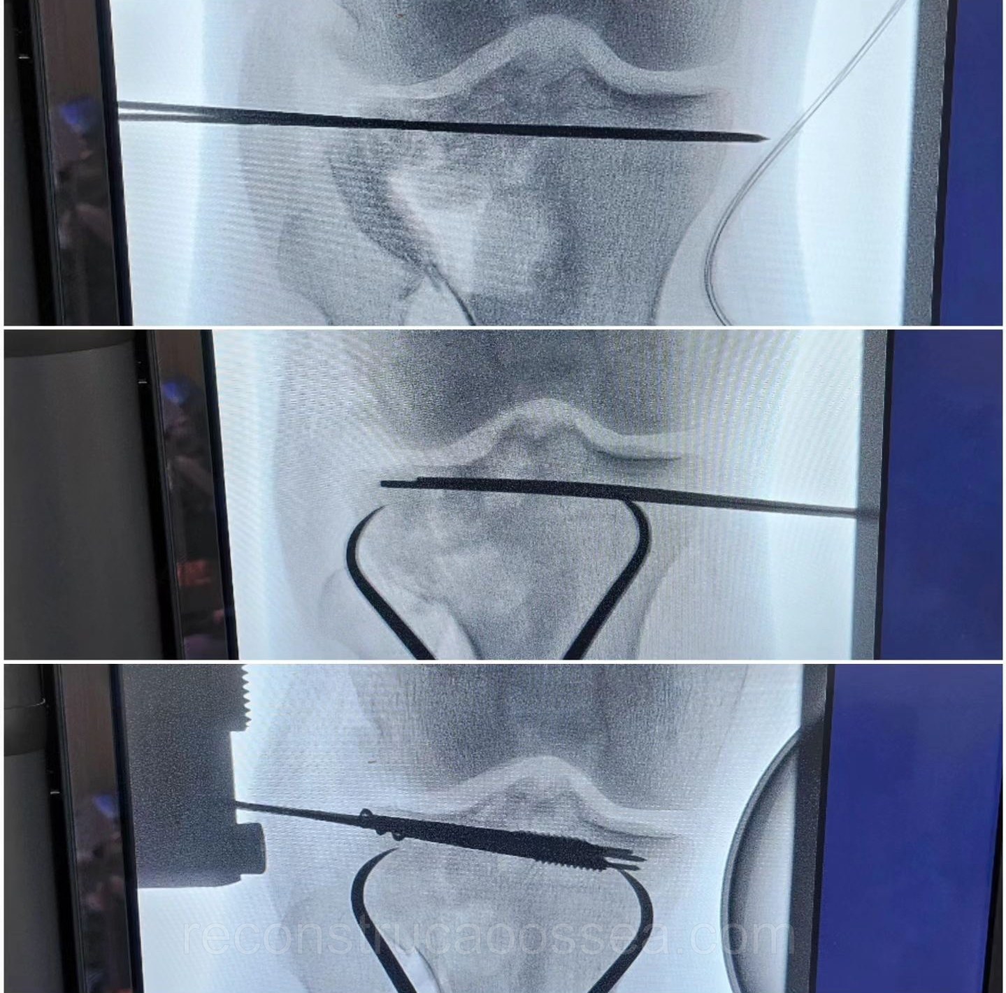 fratura-do-planalto-tibial-tratamento-cirurgico-15