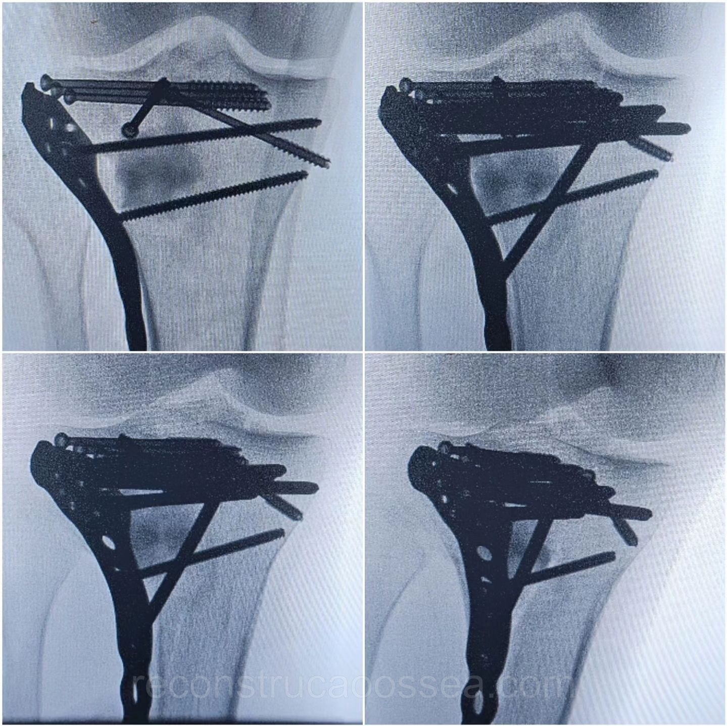 fratura-do-planalto-tibial-tratamento-cirurgico-16