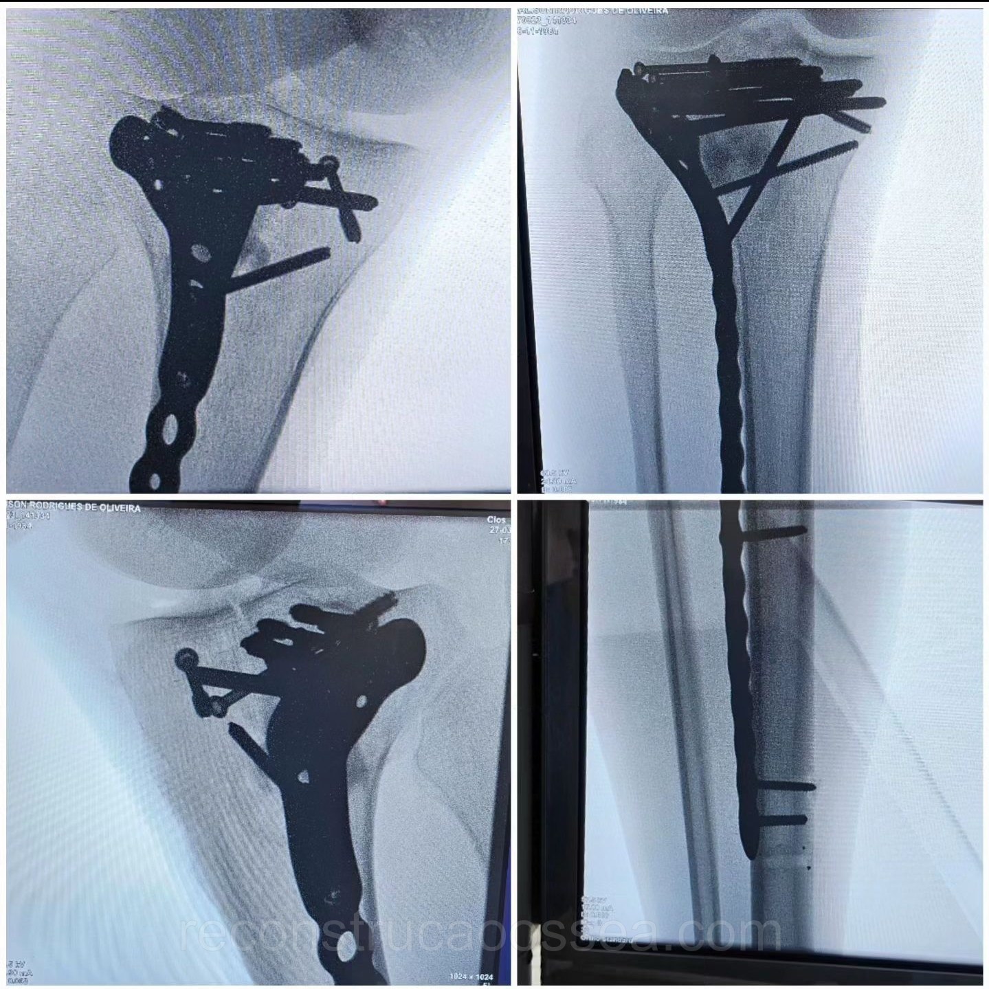 fratura-do-planalto-tibial-tratamento-cirurgico-17