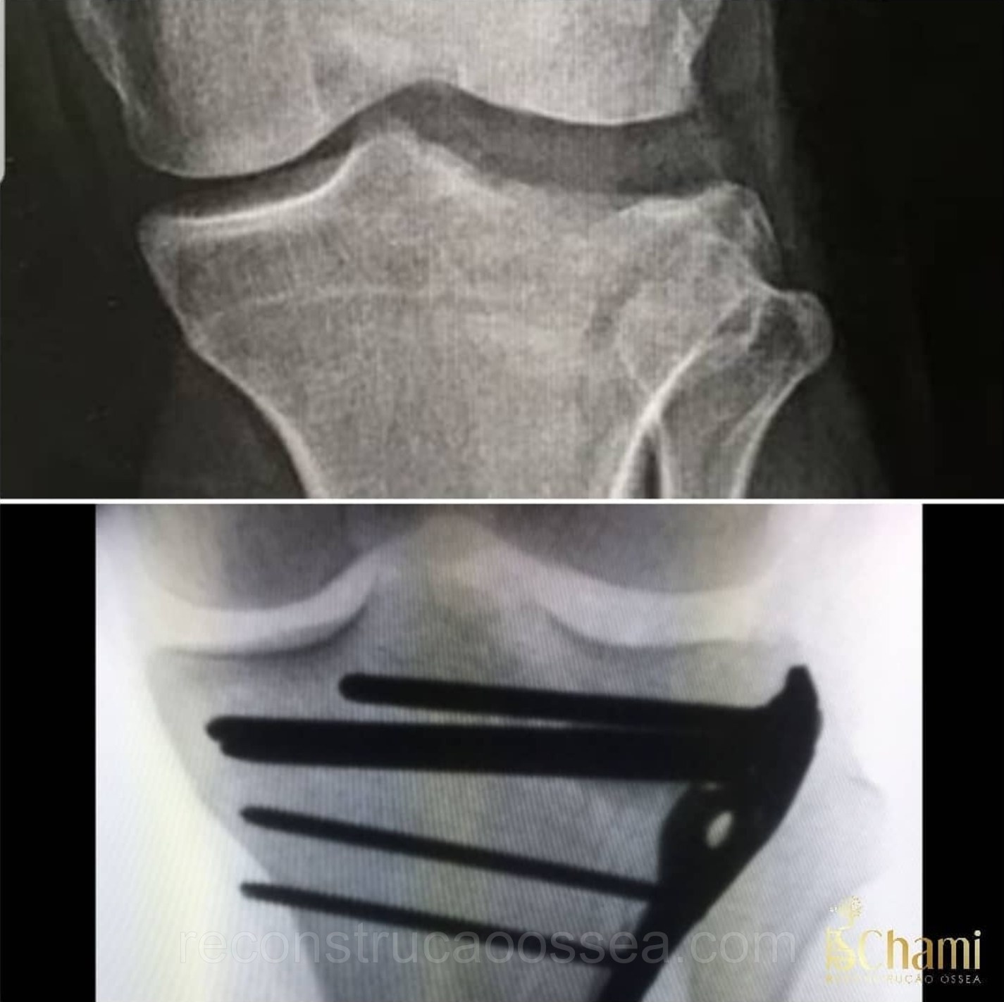 fratura-do-planalto-tibial-tratamento-cirurgico-2