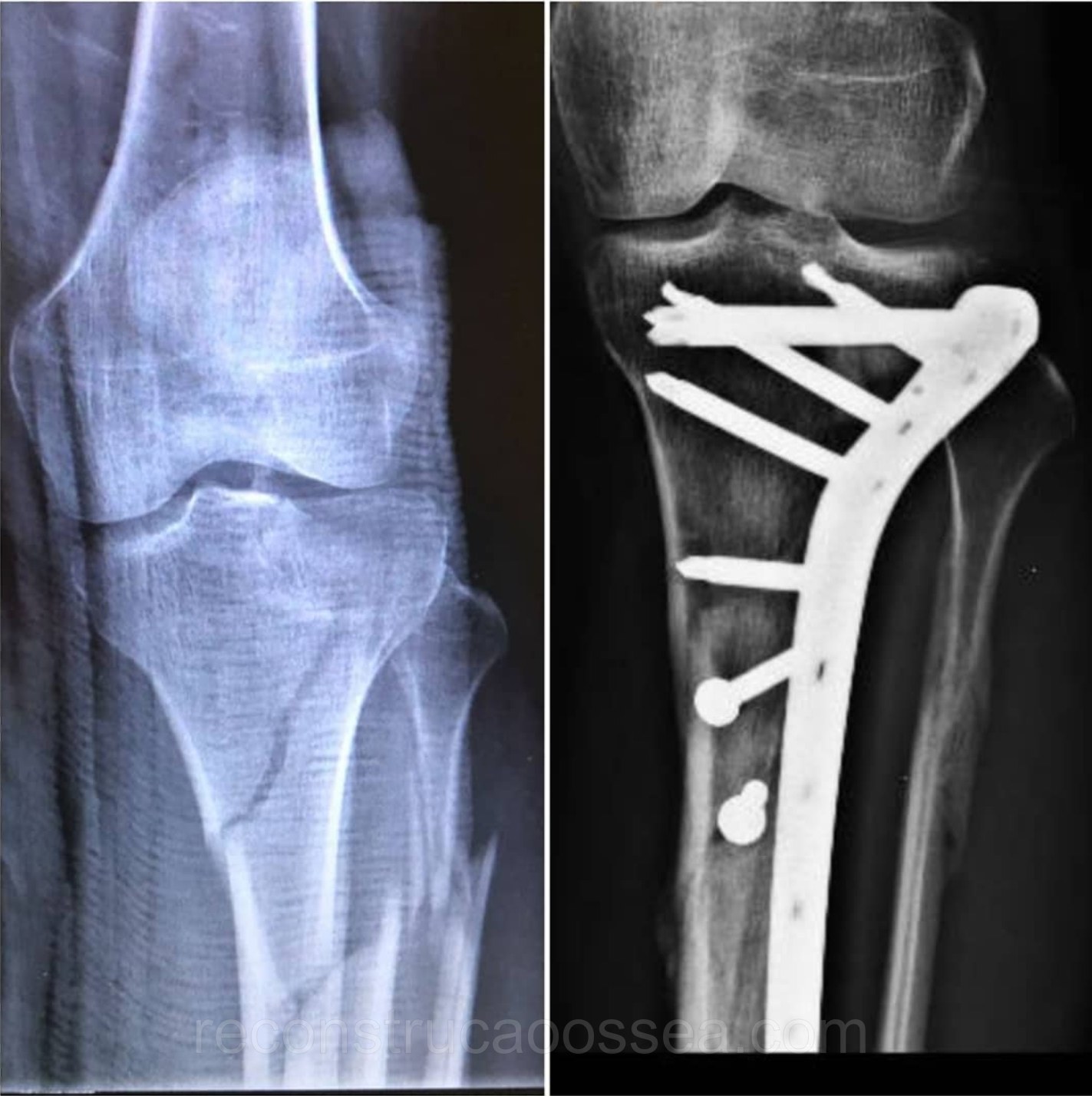 fratura-do-planalto-tibial-tratamento-cirurgico-4