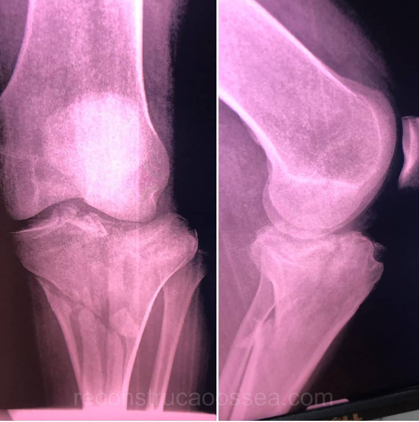 fratura-do-planalto-tibial-tratamento-cirurgico-6