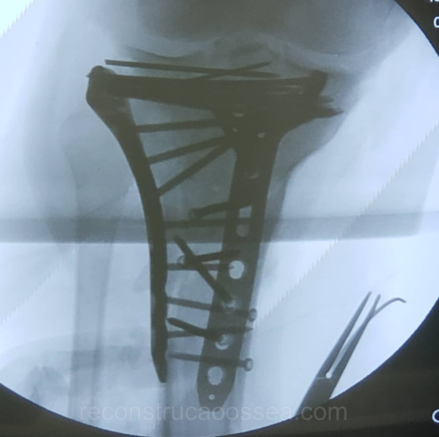 fratura-do-planalto-tibial-tratamento-cirurgico-8