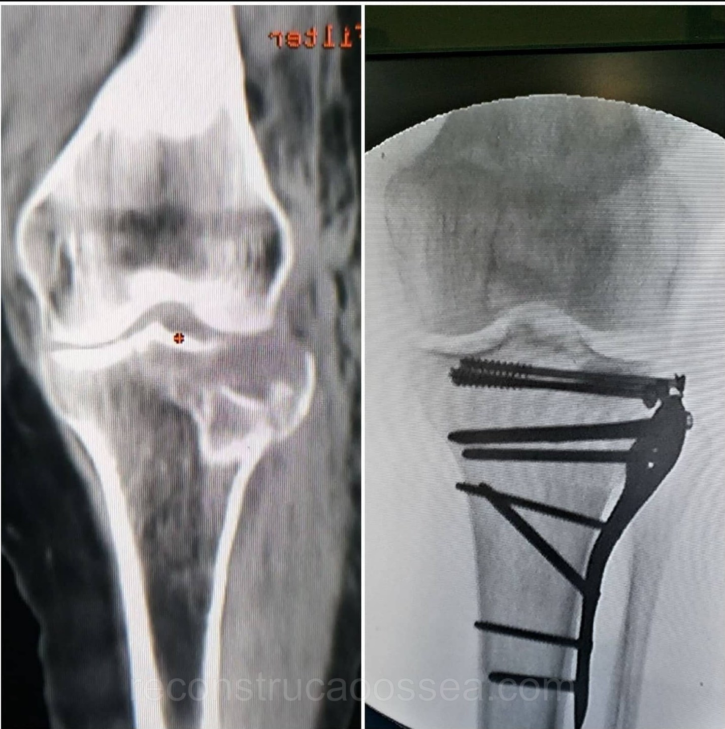 fratura-do-planalto-tibial-tratamento-cirurgico-9