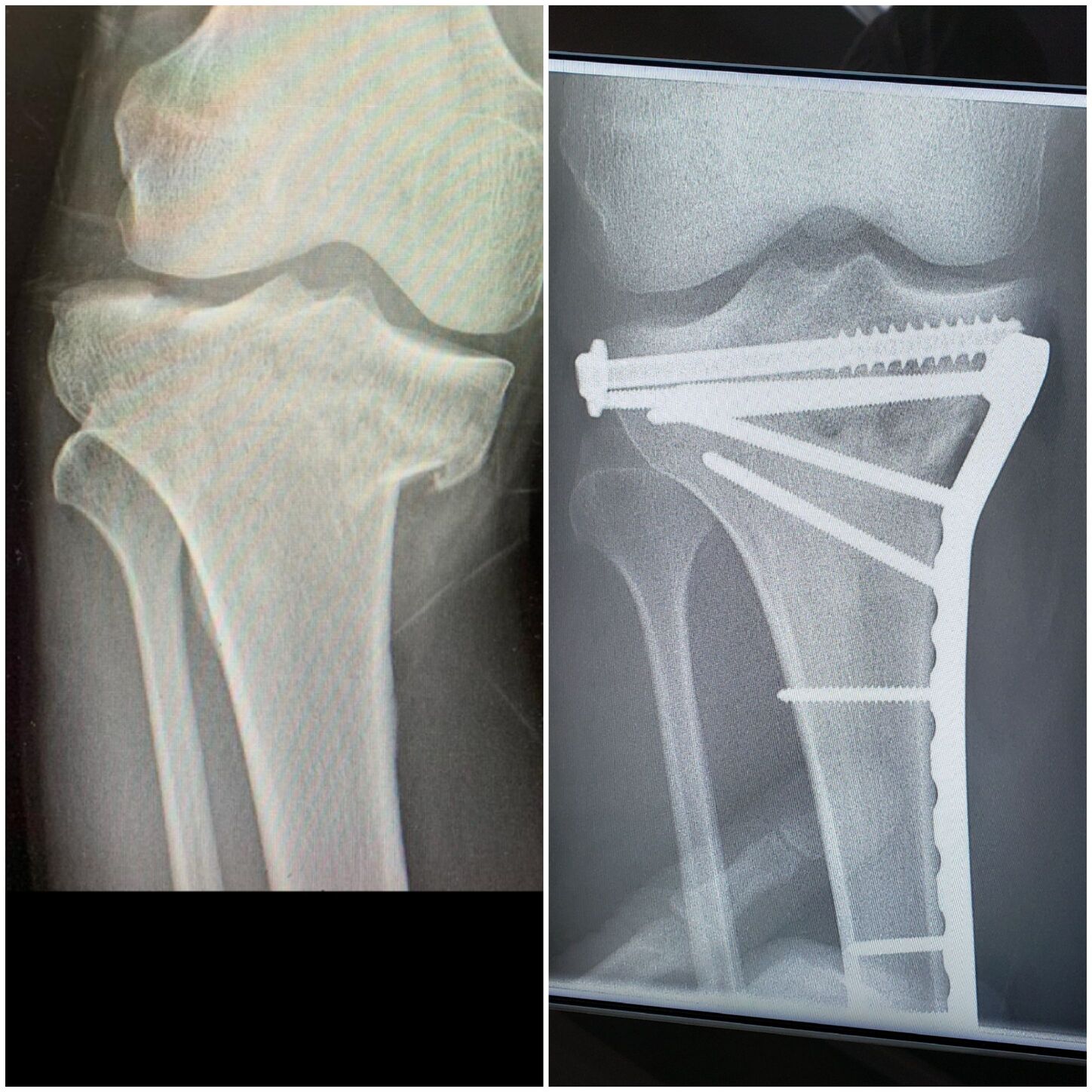 fratura-do-planalto-tibial