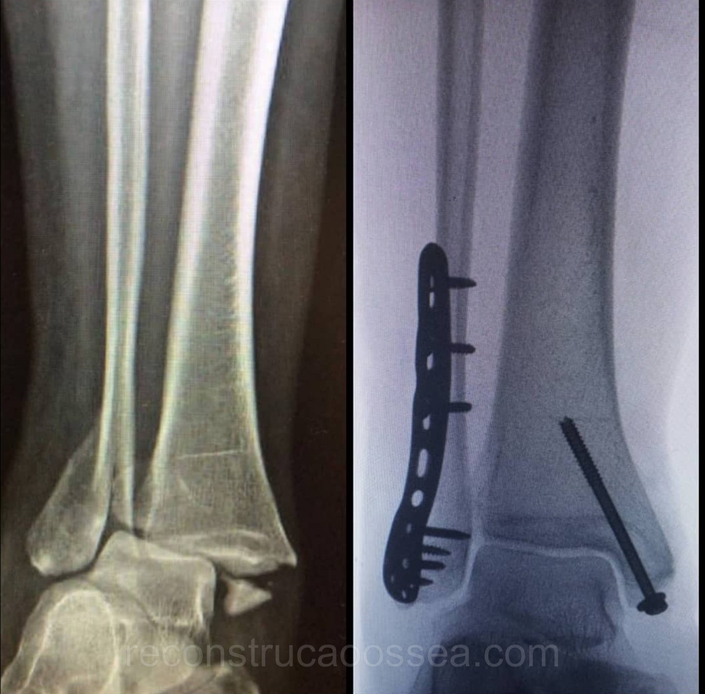 fratura-do-tornozelo-tratamento-cirurgico-1