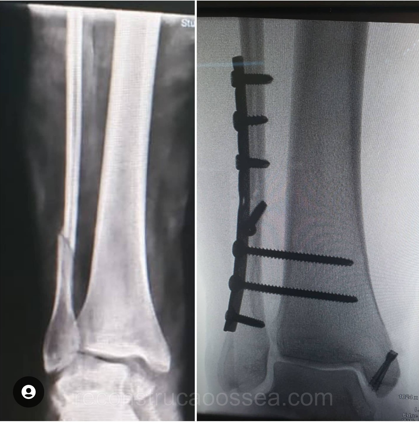 fratura-do-tornozelo-tratamento-cirurgico-11