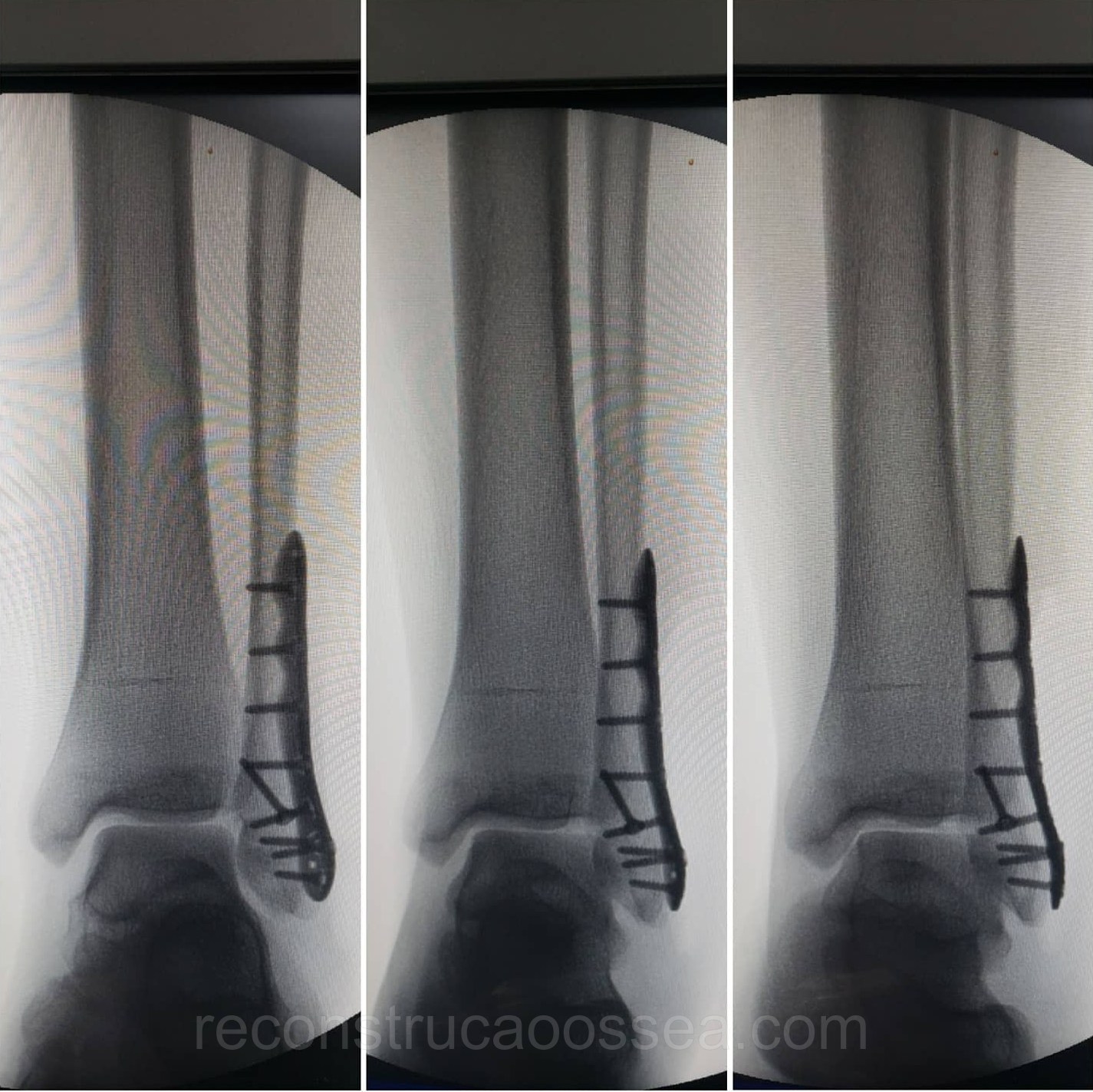 fratura-do-tornozelo-tratamento-cirurgico-14