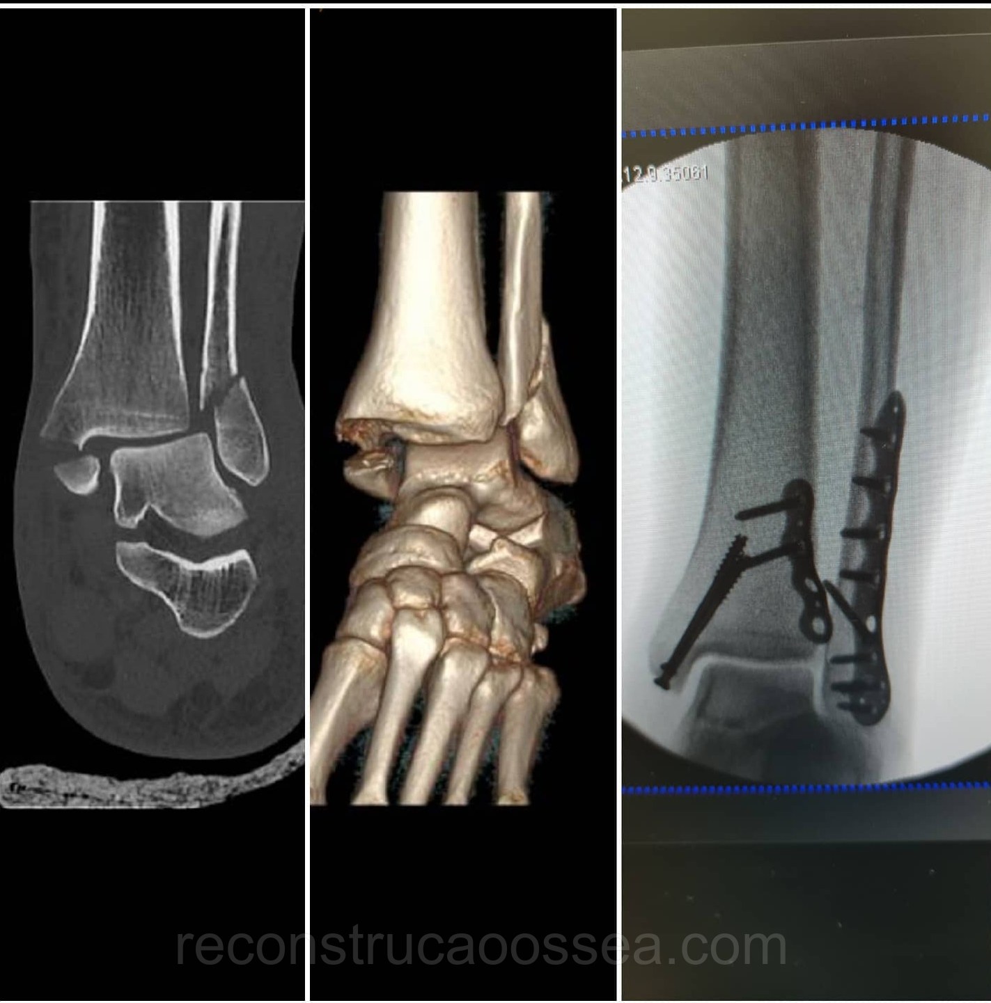 fratura-do-tornozelo-tratamento-cirurgico-17