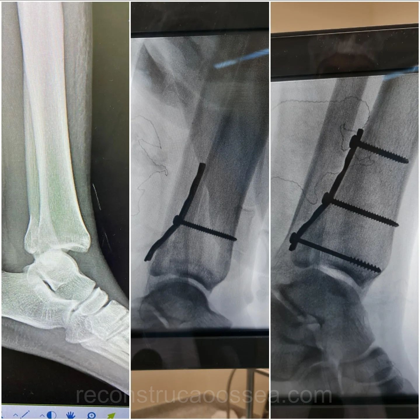 fratura-do-tornozelo-tratamento-cirurgico-18